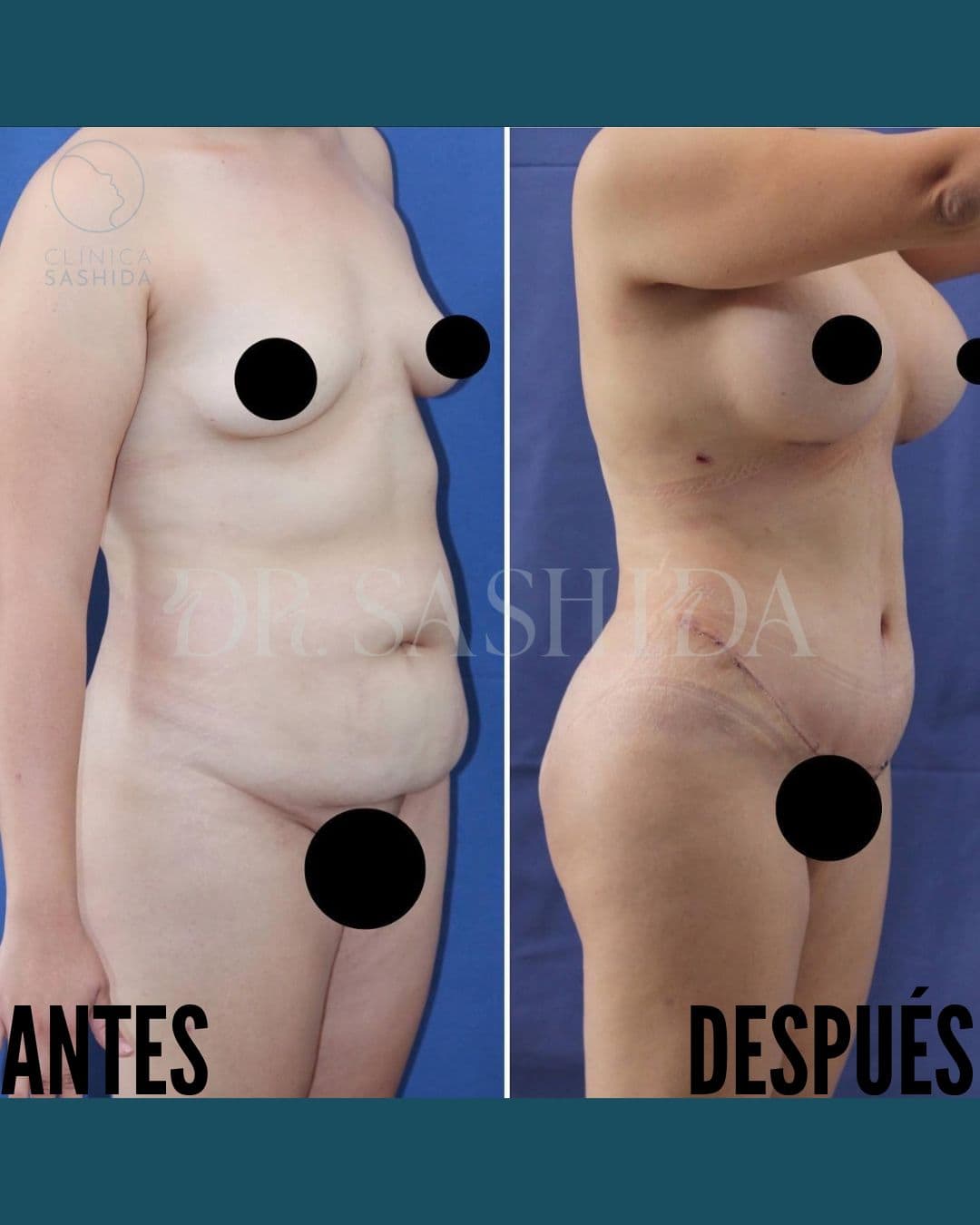 Caso de contorno corporal del Dr. Hirosi Sashida — antes y después