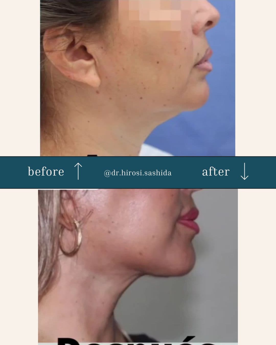 Caso de lifting facial del Dr. Hirosi Sashida — antes y después