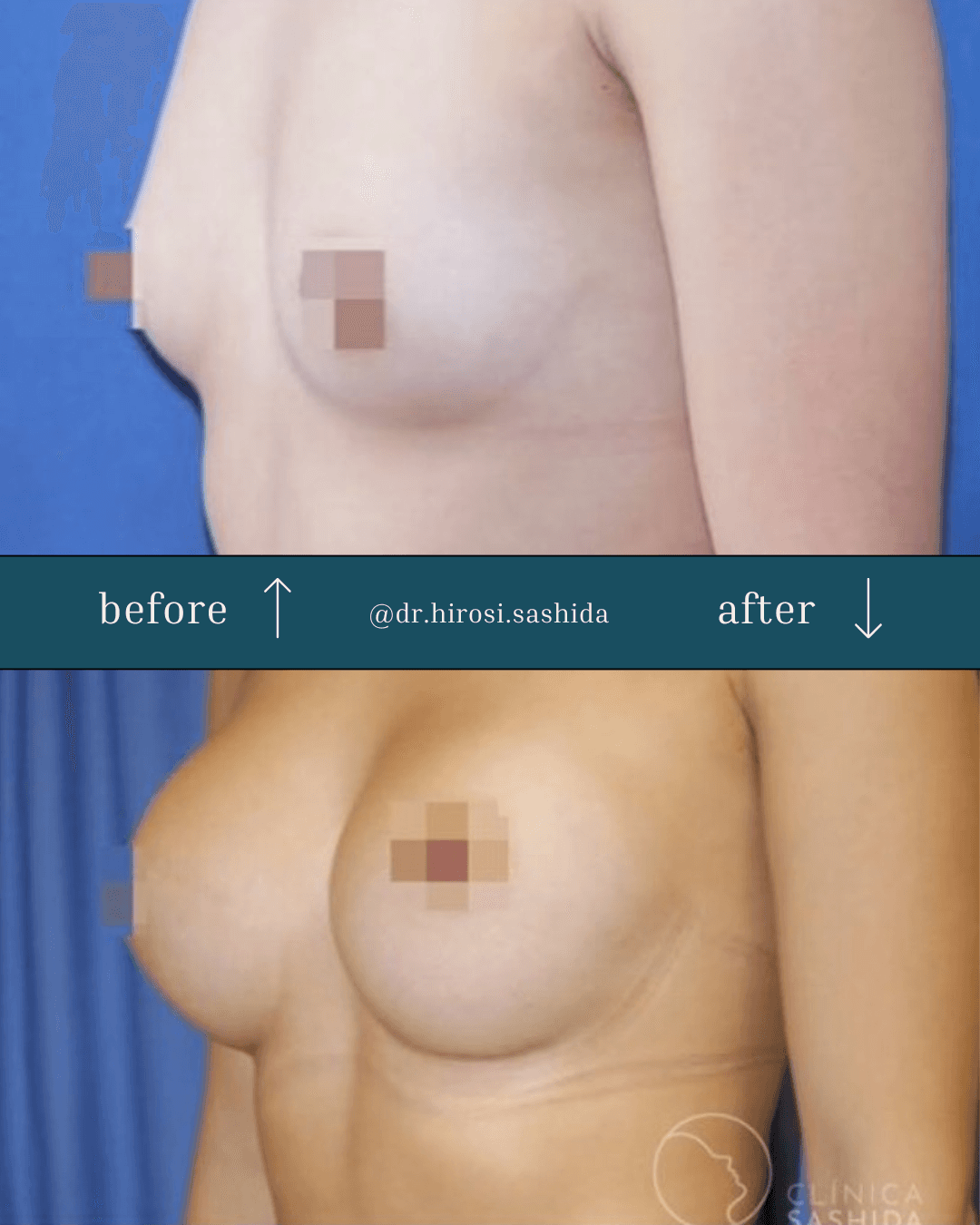 Caso de mamoplastia del Dr. Hirosi Sashida — antes y después