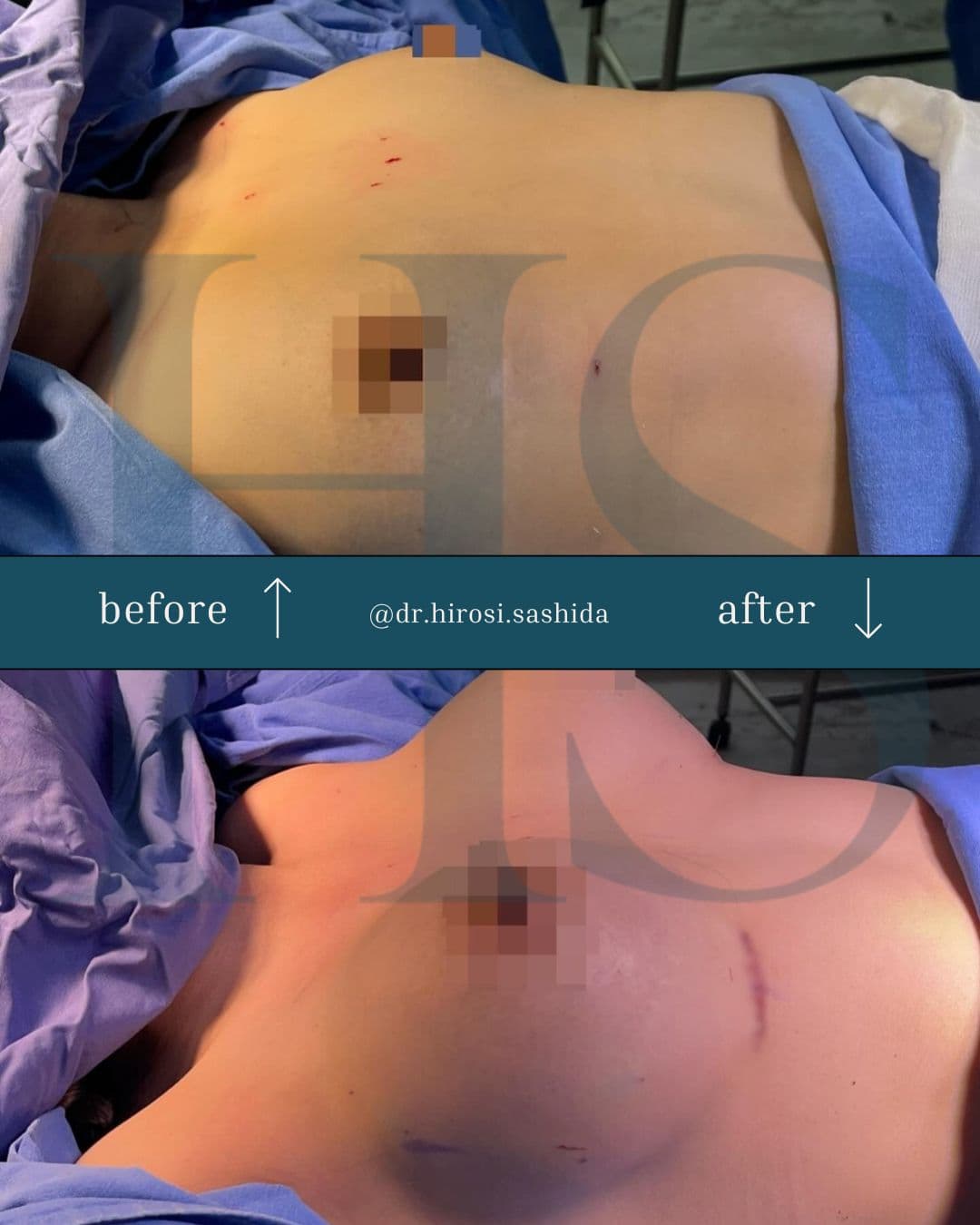 Caso de mamoplastia del Dr. Hirosi Sashida — antes y después