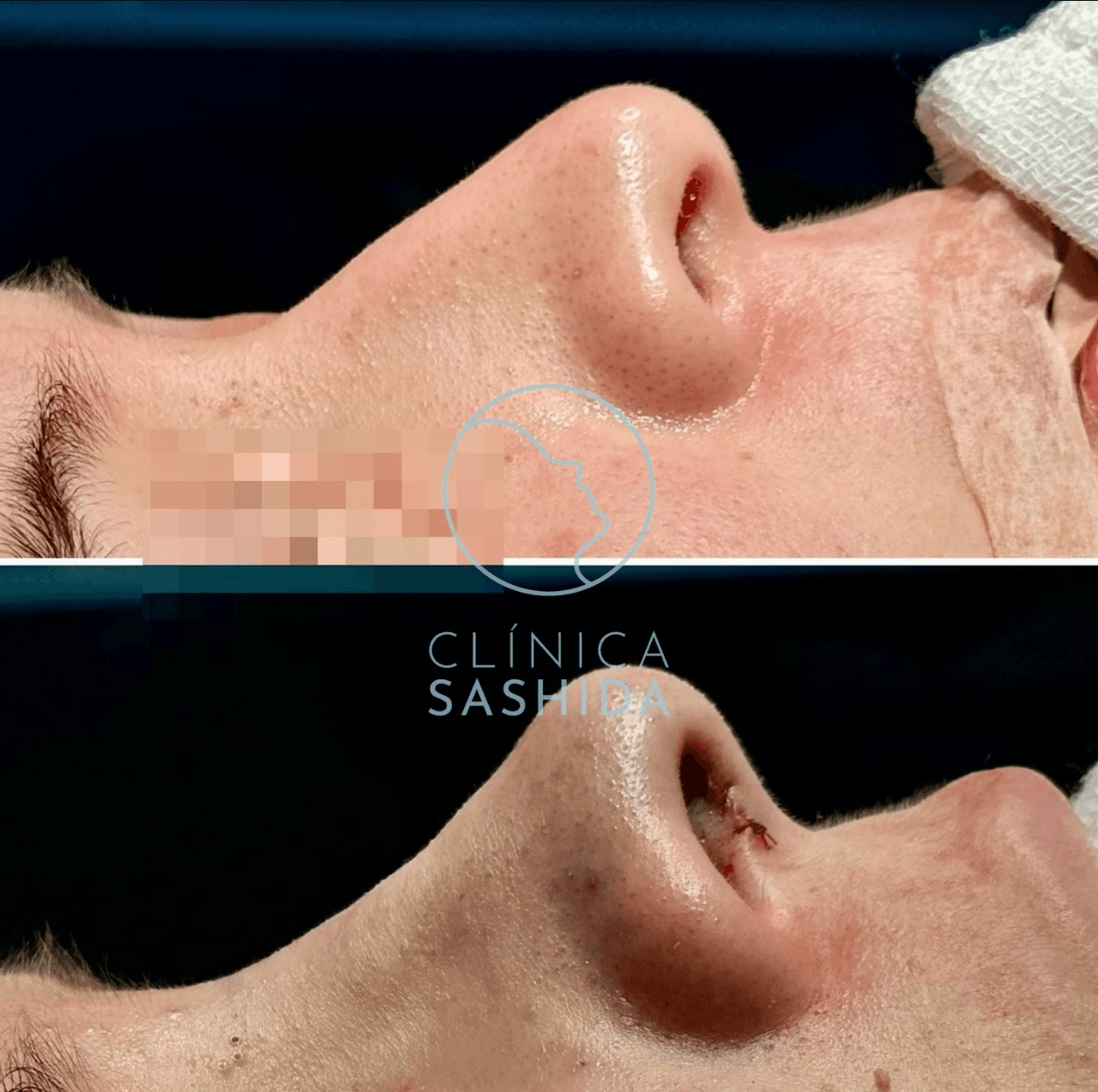 Caso de rinoplastia del Dr. Hirosi Sashida — antes y después