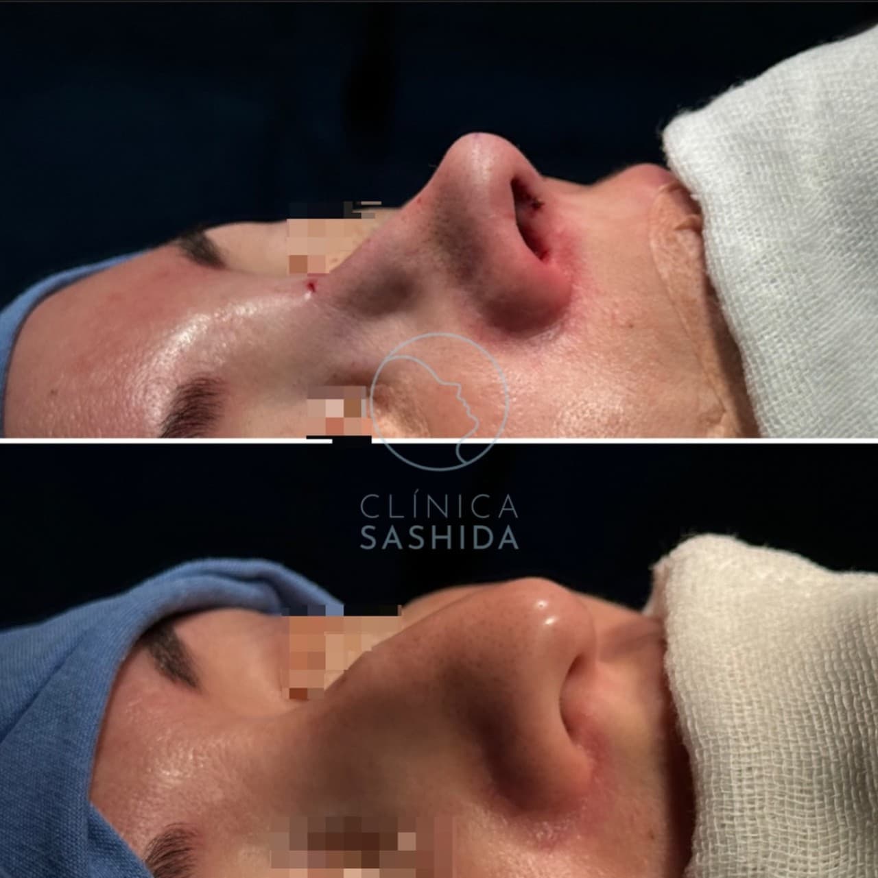 Caso de rinoplastia del Dr. Hirosi Sashida — antes y después